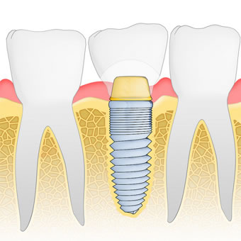 dental implants