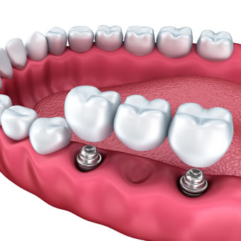 implant supported dentures